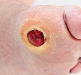 Diabetic foot ulcers