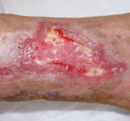 Leg ulcer