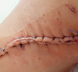 Surgical staples/sutures