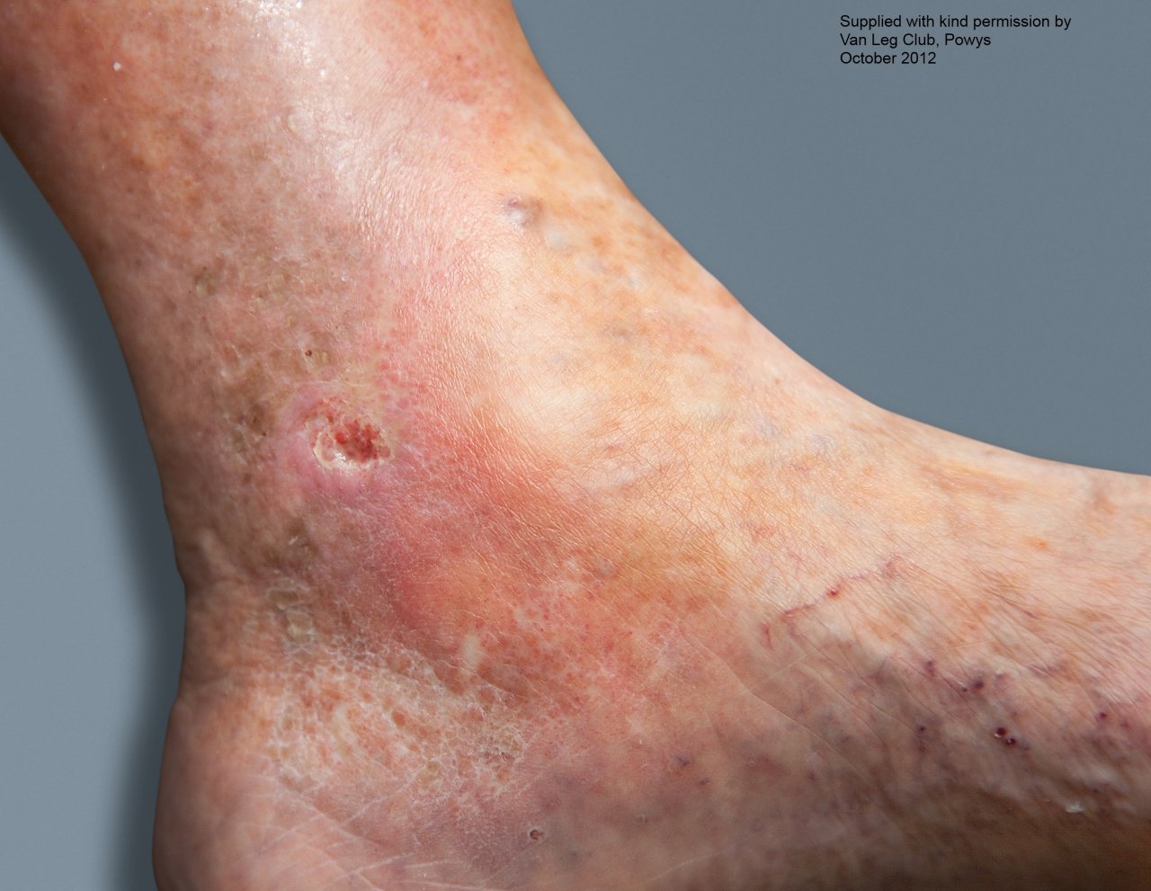 leg ulcers treatment