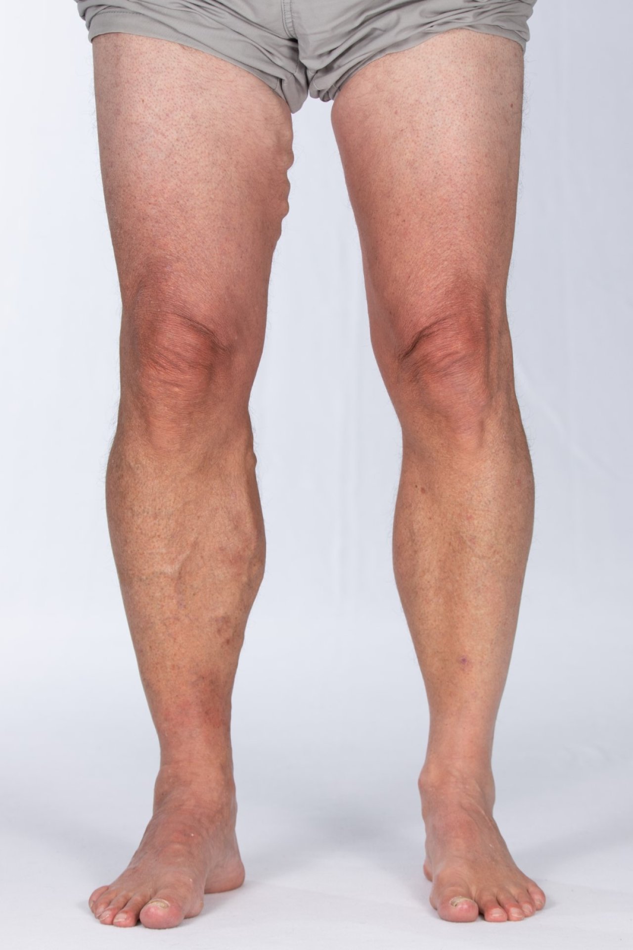 https://lrselfcare.co.uk/img/containers/assets/conditions/varicose-veins.jpg/a16e00a6d6513e026d59caca2c0b8a79.jpg